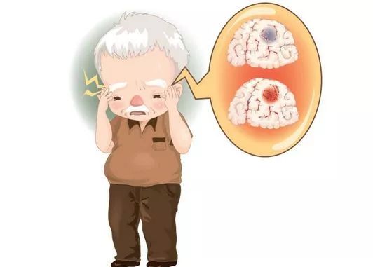 帕金森早期的症状 帕金森早期的症状